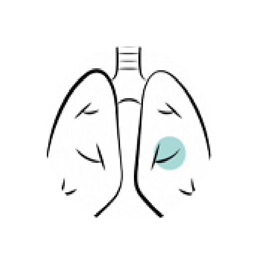 Image de poumons atteints d'une maladie pulmonaire interstitielle.