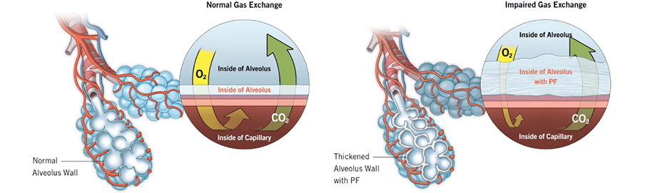 A comparison of normal lung air sacs versus thickened air sacs that are present in interstitial lung diseases.